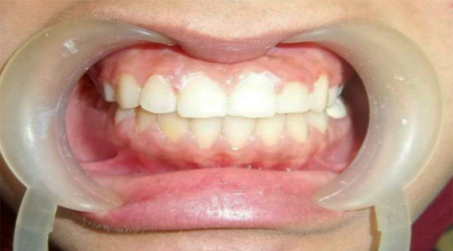 بعد تقويم وعلاج الاسنان بمركز دكتور ايمن الغمراوى -تركيب وتجميل الاسنان 4